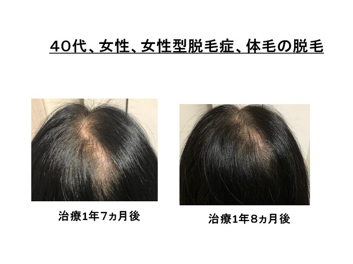 円形脱毛症　病院